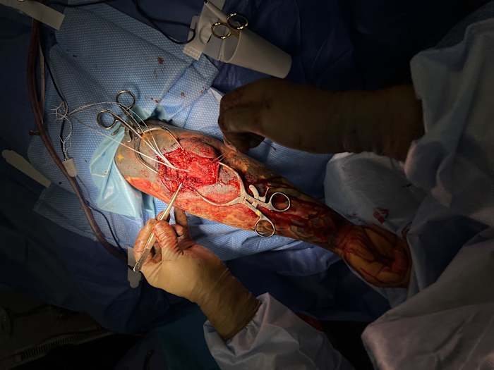 The triceps surgery (Courtesy of Josh Alexander)